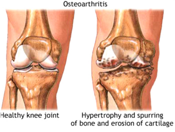 JOINT DISORDERS